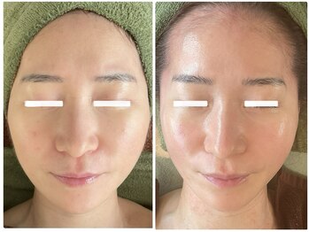 ルミエール フォレストサイド(L’MIERE forestside)/お顔の怠け筋を鍛えるケア