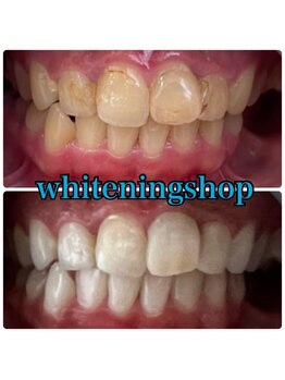 ホワイトニングショップ 日進店/Before After日進ホワイトニング