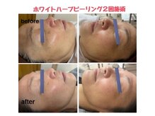 マナ(mana)の雰囲気(再生と強化の二刀流☆チクチク微細針ハーブピーリングで美肌へ)