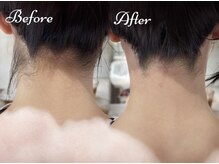 ピミル(PIMIL)/うなじ脱毛