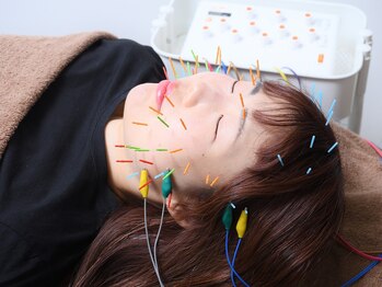 ウル鍼灸整骨院の写真/むくみ解消スッキリ小顔とリフトアップのケアで自分へのご褒美を!美容鍼で心まで整える癒しの時間を☆