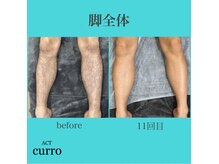 アクト クロ(ACT curro)/【脚全体】脱毛施術例