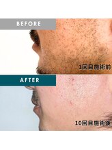 モモナ(Momona)/佐世保/脱毛/髭脱毛/全身脱毛