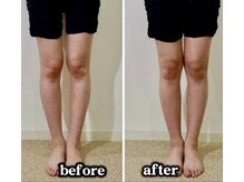 アズール(azure)/美容矯正での、骨盤・O脚矯正