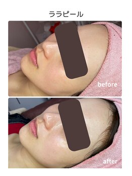 シフォン(Chiffon)/ララピールシンプルコース