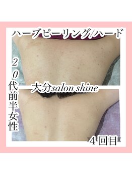 サロンシャイン(Salon Shine)/背中ハード4回