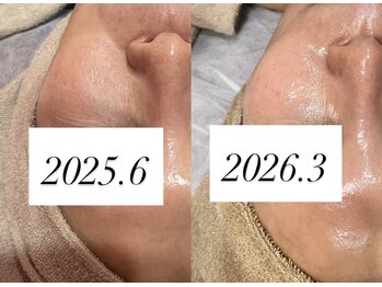 チュベルフェ(tu belle fe)の写真/【老け見えSTOP】たるみ/ほうれい線に◆1回で引き上がりを実感◆小顔×毛穴レス/ギノーVAR