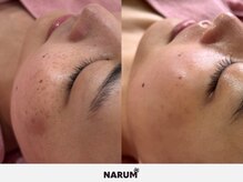 ナルムフェイシャル 代々木(NARUM facial)/毛穴洗浄/白玉ピーリング