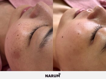 ナルムフェイシャル 代々木(NARUM facial)/毛穴洗浄/白玉ピーリング