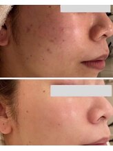 エラフリー/水素フェイシャルは1回でも効果