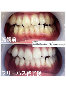 ホワイトニングサロン 京都烏丸店/ホワイトニング施術例