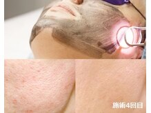 ナチュレアンドメディカ(Nature&Medica)/毛穴特化ケア（YAGカーボン）