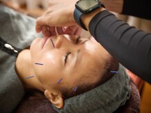 鍼灸整体ラクーナ/施術の様子３