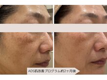 ユーブルーム(youbloom)/ADSで肌改善☆