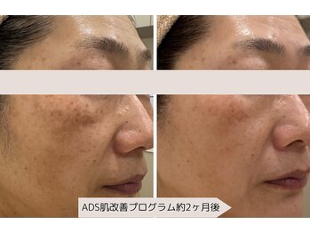 ユーブルーム(youbloom)/ADSで肌改善☆