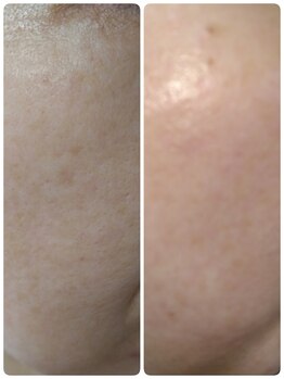 ラ ナチュール(La Nature)/リジュランピーリング(雪花)