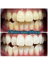 ホワイトニングショップ 吉祥寺店/BEFORE ＆ AFTER