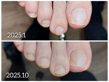 爪切り屋 足楽/【自爪育成】爪の剥離