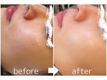 パールホワイトニングサロン 茅ヶ崎店/ハーブピーリング