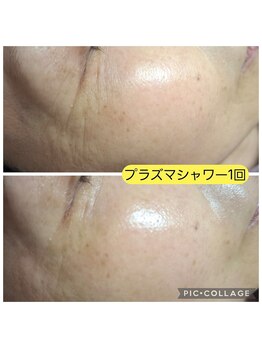 ハナ(HANA)/プラズマシャワー1回の結果