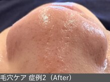 オアシスラグーン(OASIS LAGOON)/毛穴ケア（症例2 after）