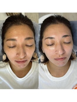 サニーヒルズ ウィズ マキア 藤沢(Sunny hills with MAQUIA)/高濃度炭酸パック