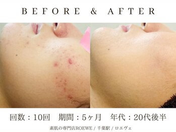ロエヴェ(ROEWE)/ニキビ改善・毛穴ケア・肌質改善