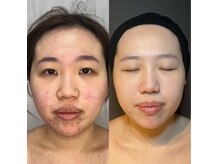 エラ(ella)の雰囲気（本気の肌質改善をするなら！ハーブピーリング★）