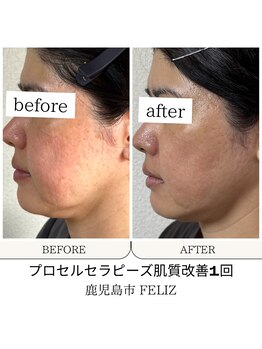 フェリス(FELIZ)/肌質改善プロセルセラピーズ