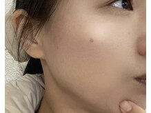 バーテックスキー(Vertexkey)/肌質改善