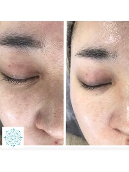 ルヴィ 藤岡店(REVI)/シミやくすみの改善も