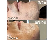 メンズ人気No.1ひげ脱毛☆大得意です(富山布瀬店実績)