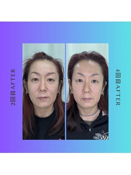 たいよう美容鍼灸院/Before After