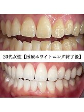 ホワイト 福岡博多店(WHITE)/ホワイトニングビフォーアフター