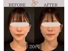 チョコバリ 新宿店(chocobari)/小顔×リフトアップ(美容鍼)20代