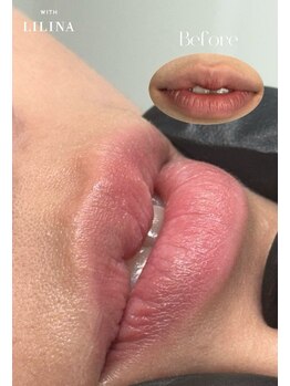 ウィズリリナ 新横浜(with Lilina.)/メラニン色素に反応★