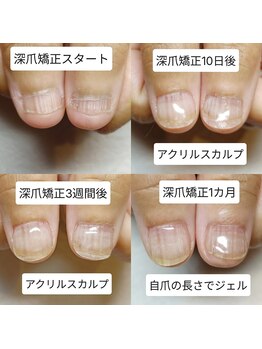 マニエネイル(mani e nail)/深爪矯正サロンができること