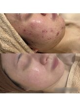 リンダ(Rinda)/ハーブピーリング【ニキビ改善】