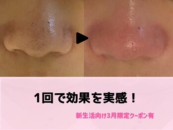 ライゼ(REISE)/ビフォーアフター【毛穴/小顔】