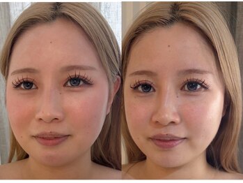 エルドットサナ(L.sana)/小顔矯正