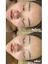 エクラ(ECLAT)/ピーリング×高濃度ビタミン導入
