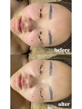 エクラ(ECLAT)/ピーリング×高濃度ビタミン導入