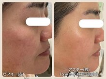 オリーブ(Olive)の雰囲気（50代　頬の赤みが落ち着き、毛穴も引締まり／小顔　毛穴ケア）