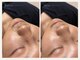ソア(Soa)の写真/ガンコな毛穴汚れやテカリが気になる男性へ！毛穴洗浄で好印象な素肌を目指すフェイシャルケア◎