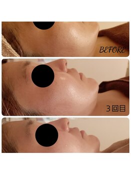 レーヌ青山(Reine Aoyama)/【施術】インディバフェイシャル