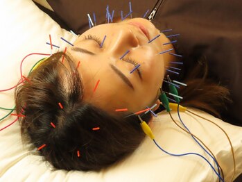 ハリンカ 札幌(HARINKA)の写真/全身鍼灸＋美容鍼で内臓機能を高めてハリのあるお肌へ♪ストレスによる肌荒れや胃腸の不調でお悩みの方も◎