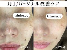 トリニエンス 新宿店(TRINIENCE)/40代/シミケア/パーソナルケア