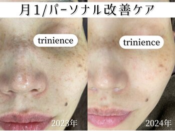 トリニエンス 新宿店(TRINIENCE)/40代/シミケア/パーソナルケア