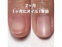マリーシーオー(MARY-CO.)の雰囲気（深爪矯正/2ヶ月経過(ホームケアでオイル1本使用)）