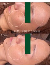 エミルカ 土岐店(EMILUCA)/薄いシミでお悩みの方